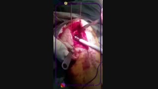 فیلم تعویض مفصل ران در بیمار پنجاه ساله