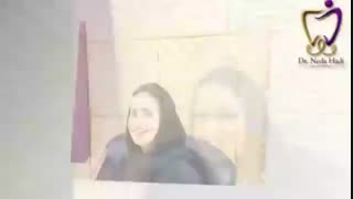 اصلاح فرم دندان ها با ونیر کامپوزیت