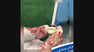 جراحی دیسک گردن