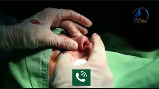 فیلم جراحی زیبایی بینی بلافاصله بعد از اتمام جراحی بینی