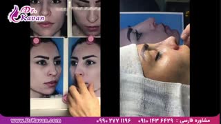 عمل بینی توسط دکتر کاوان