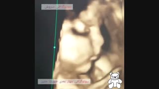 فیلم سونوگرافی چهار بعدی صورت جنین