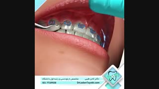 جراحی فرنوم ( فرنکتومی ) | دکتر لادن طیبی اینسایزینگ