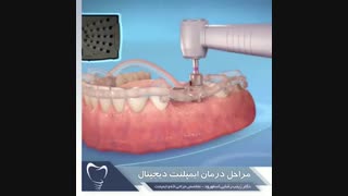 مراحل درمان ایمپلنت دیجیتال | دندانستان