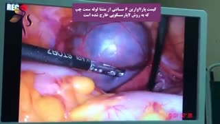درمان کیست تخمدان با لاپاراسکوپی