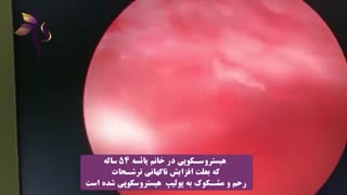 هیستروسکوپی در خانم یائسه ٥٤ ساله