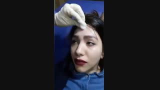 تزریق بوتاکس پیشانی کاشت ریش