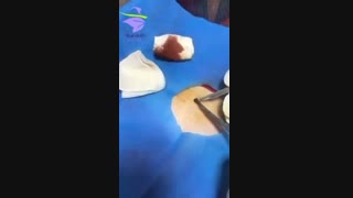 جراحی خال ناحیه شکم