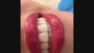 فیلم لمینیت سرامیکی دندان