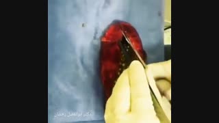 فیلم عمل جراحی سنگ کیسه صفرا