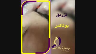 تزریق بوتاکس در ساوه