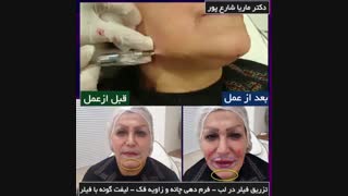 تزریق فیلر در لب