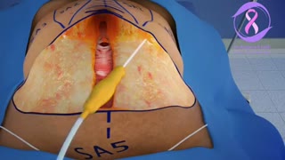 فیلم عمل لیپوماتیک یا پیکرتراشی