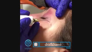 فیلم پلکسر چشم جهت رفع افتادگی چشم