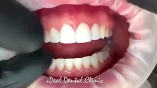 لمینت هاى سرامیکى | کلینیک ایده آل