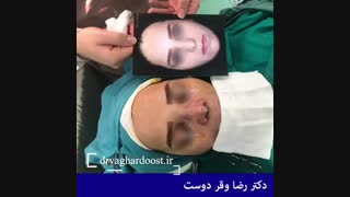 عمل زیبایی بینی