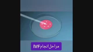 مراحل انجام ivf