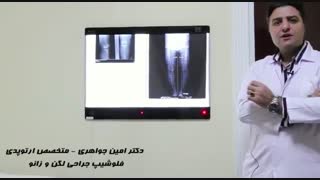 آمادگی های لازم برای جراحی تعویض مفصل زانو