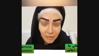 کاشت ابرو به روش جدید