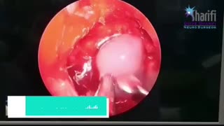 فیلم عمل تومور مغزی بزرگ از راه بینی
