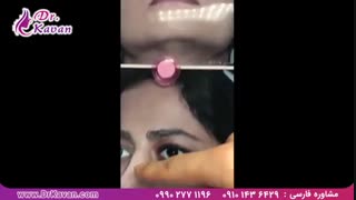 عمل بینی توسط دکتر کاوان