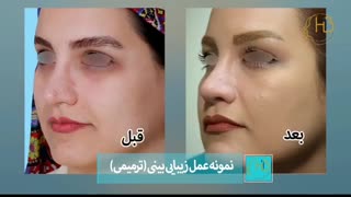 فیلم واقعی عمل ترمیم بینی