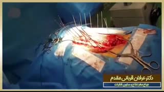 عمل جراحی اصلاح اسکولیوز