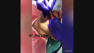 درمان لثه های نا متقارن به وسیله لیزر بدون درد و خونریزی لیزر صورت
