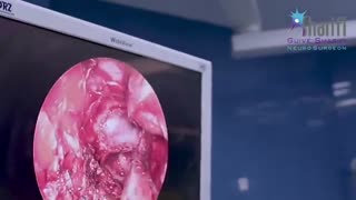 اختلال در قاعدگی و تومور مغزی