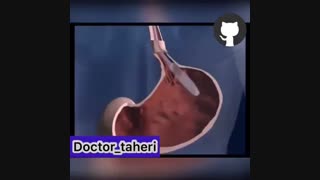 نحوه ى گذاشتن بالن معده جهت لاغرى