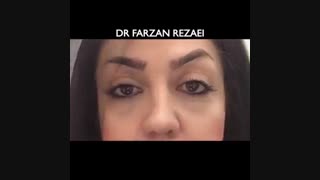 جراحی زیبایی پلک و تزریق چربی زاویه سازی صورت