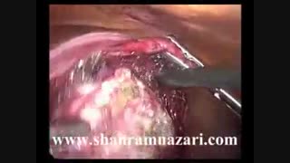 میومکتومی یک میوم بزرگ رحمی بروش لاپاروسکوپیک