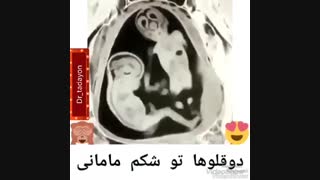 دوقلو تو شکم مامان
