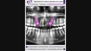 مراحل پایانی ارتودنسی ثابت | دکتر فاضل فیروزی