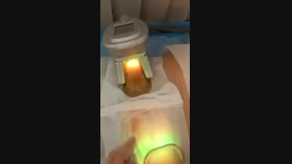 کرایو لیپولیز 3