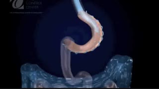 انیمیشن فیلم پلیسه معده (پلیکاسیون معده)-2