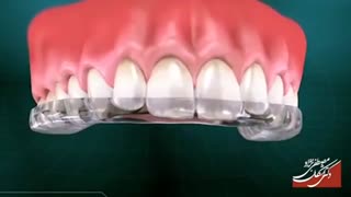 محافظ دهان (نایت گارد) | دکتر مصطفی نژاد زاویه سازی صورت